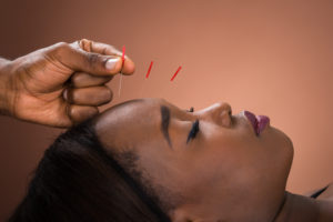 Young Woman Getting Acupuncture Treatment