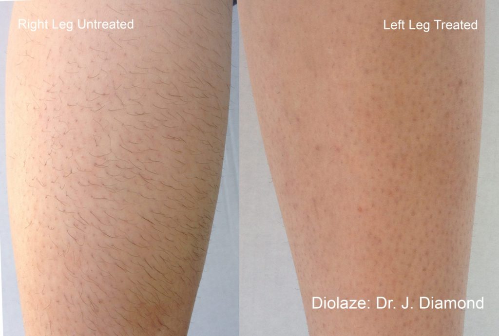 Laser Hair Removal Nava Health