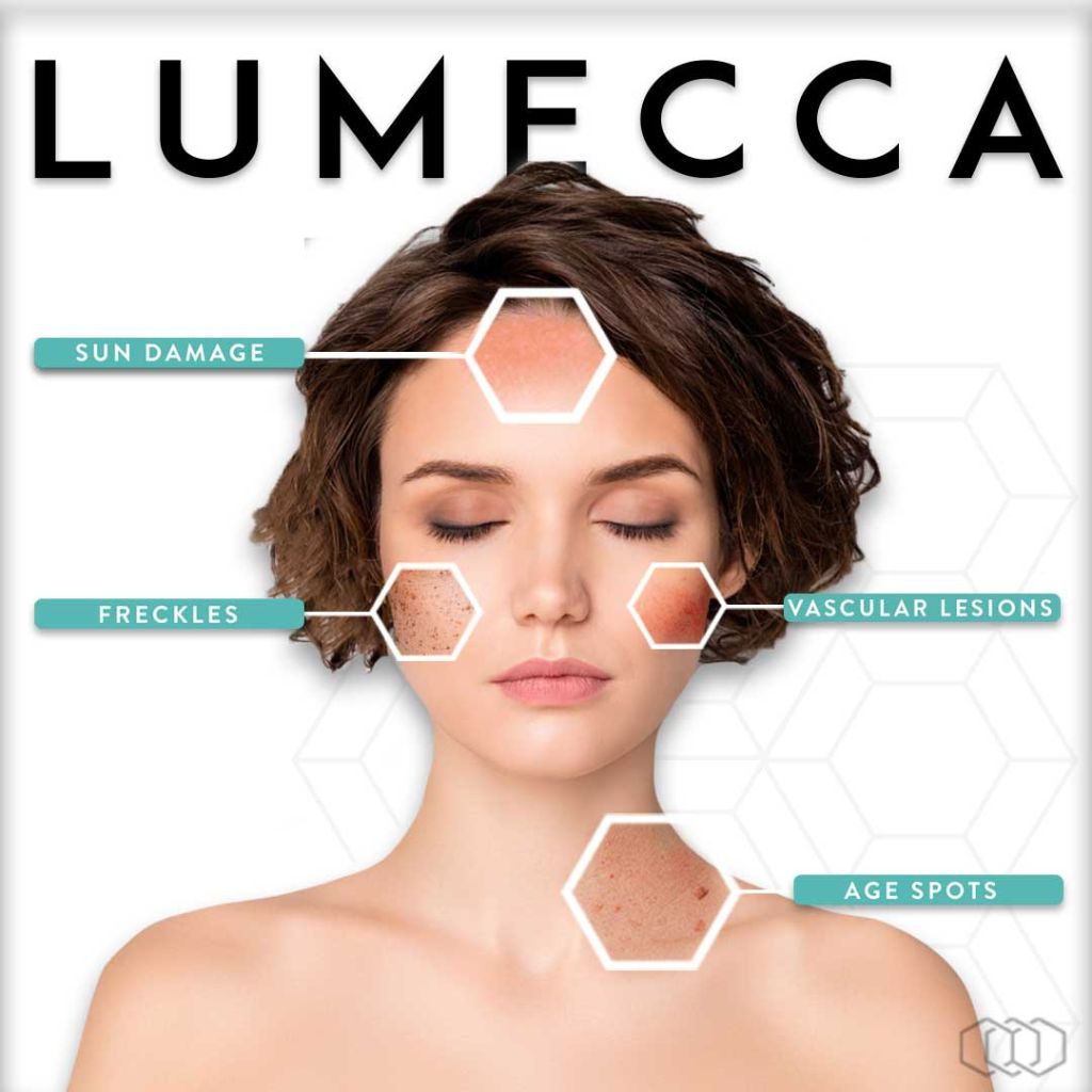 Woman who is a model of the Lumecca device lies with her eyes closed