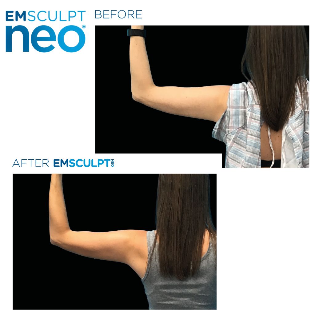 Before and after images of a womans arm, after undergoing emsculpt for three months