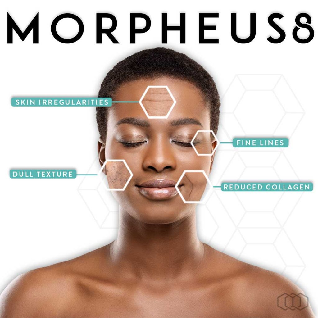 young woman with graphics outlining the results of morpheus8 microneedling technology