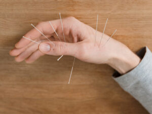 acupuncture needles on a hand to illustrate integrative medicine ideas