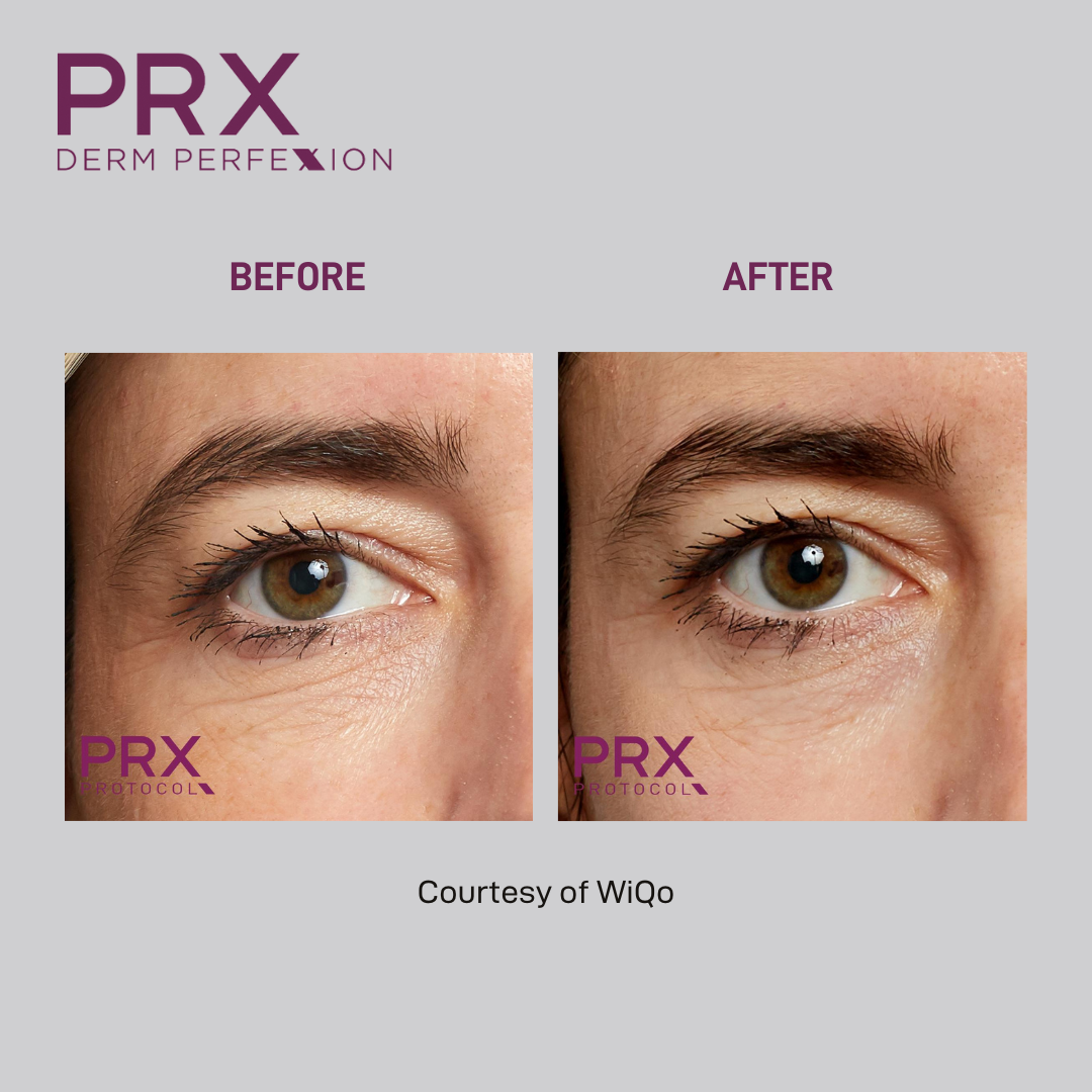 Before and after image closeup of the eyes of a woman after the PRX derm perfexion treatment