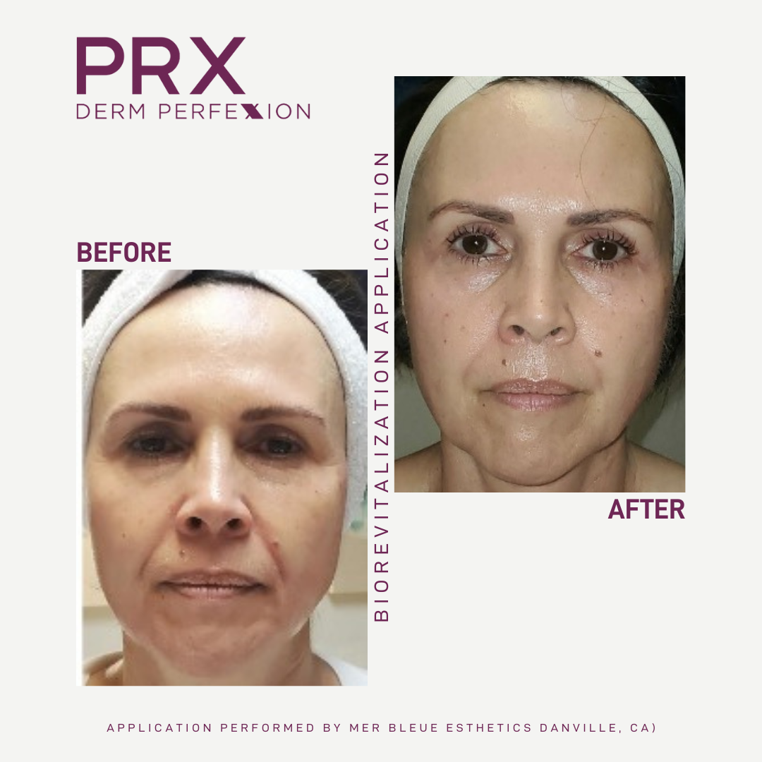 Before and after of a middle aged white woman after the PRX derm perfexion treatment