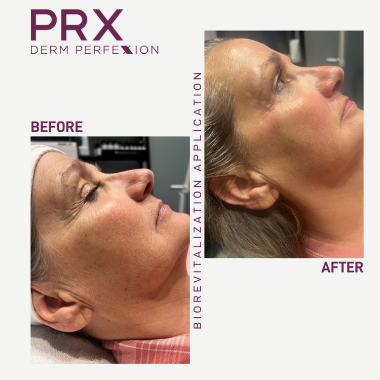 PRX before and after