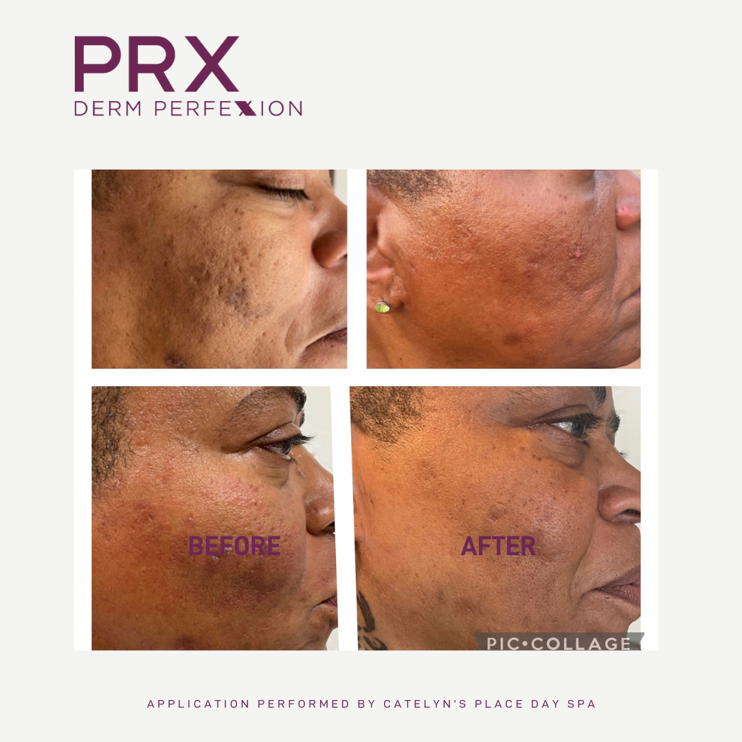 Before and after of an black woman with skin changes after the PRX derm perfexion treatment