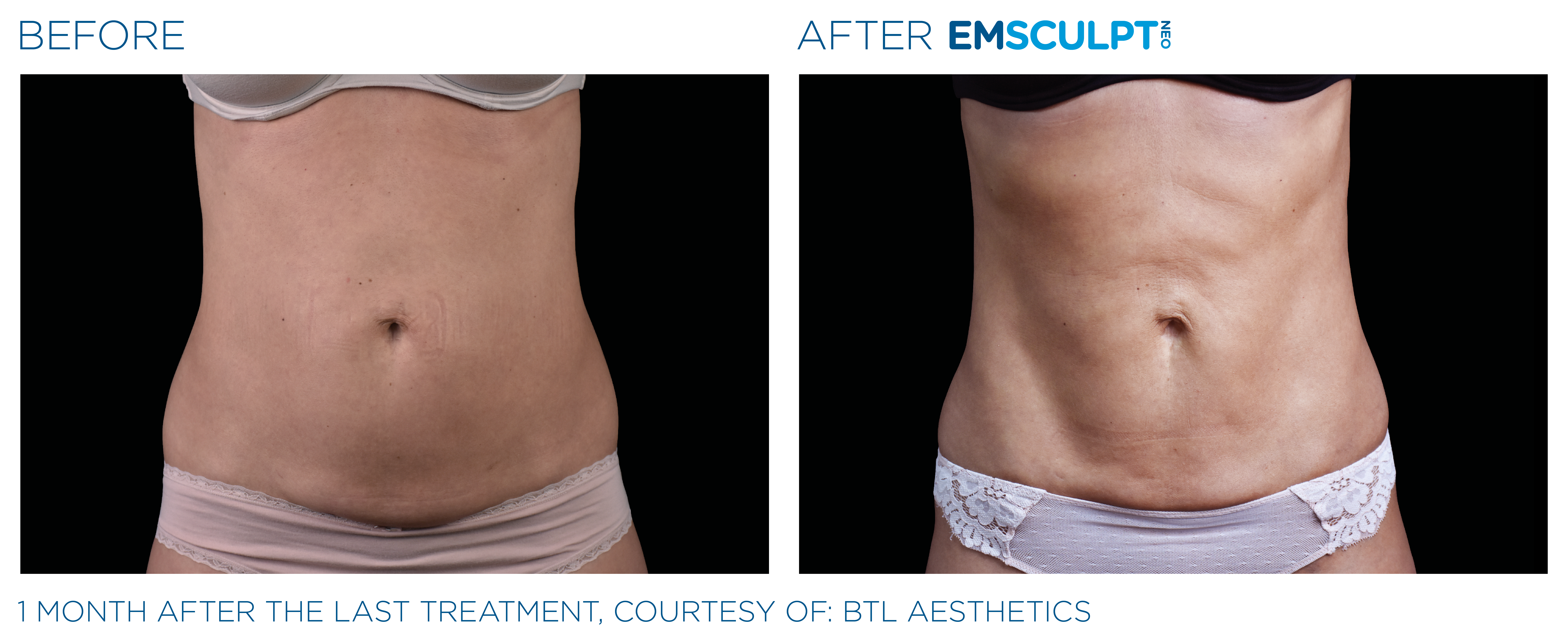 Emsculpt_Neo_PIC_Ba-card-female-lateral-abdomen-120_ENUS100 Emsculpt_Neo_PIC_Ba-card-female-lateral-abdomen-120_ENUS100