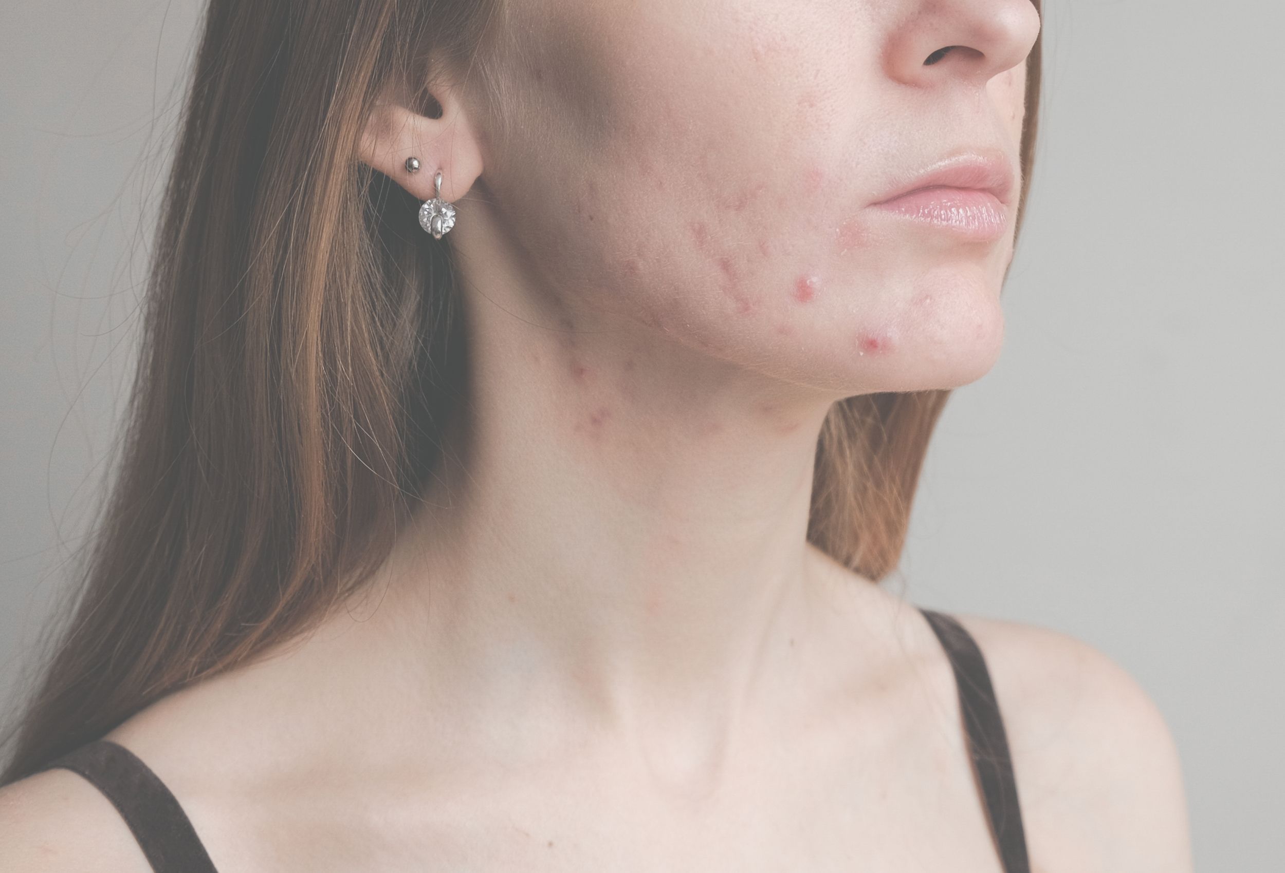 Young womans lower face with acne