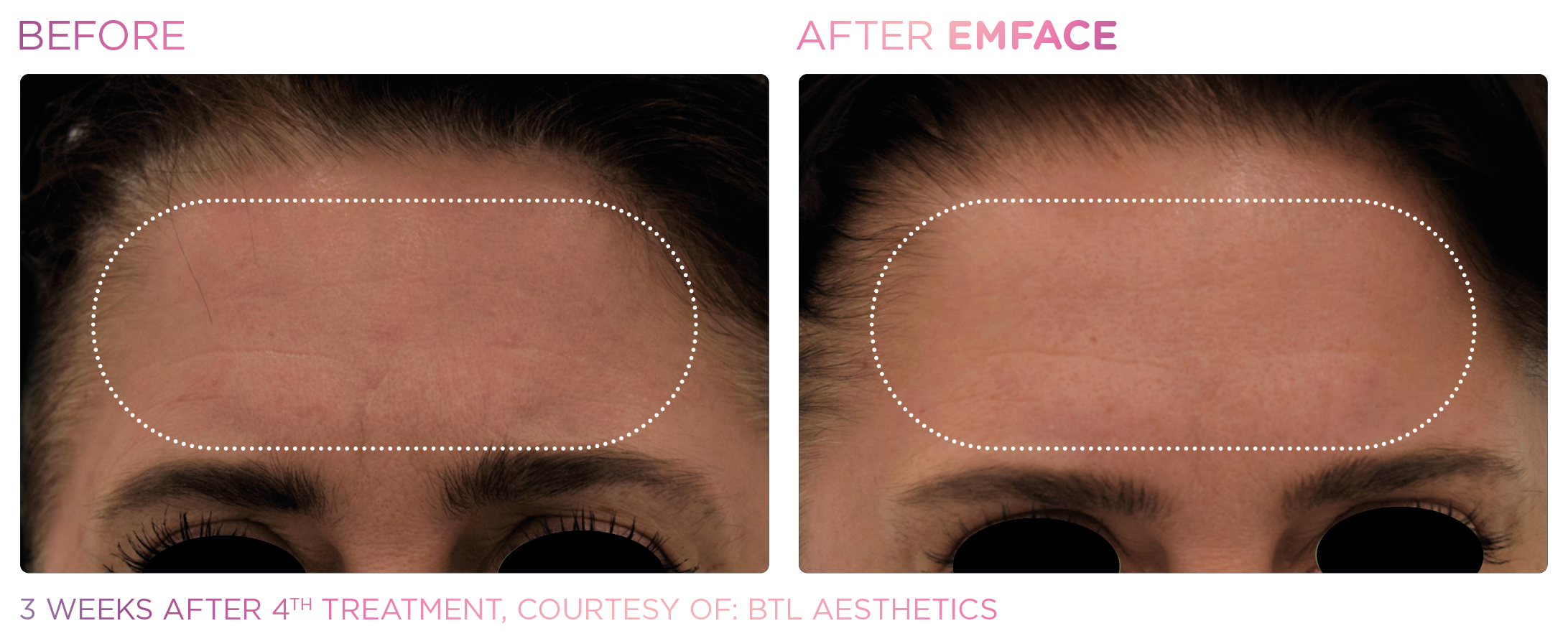 Emface_PIC_Ba-card-female-forehead-001_ENUS100 Berfore and after of forehead after EmFace