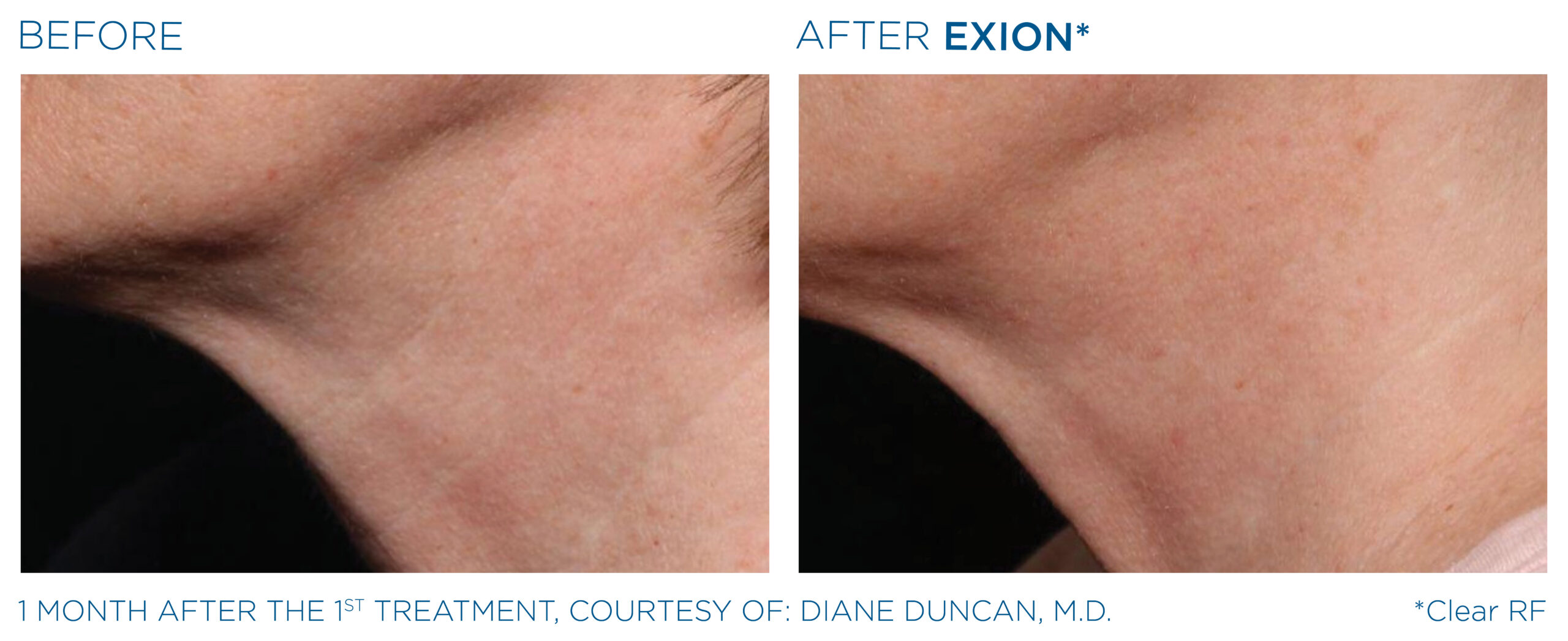 Exion_PIC_Ba-card-neck-female-003_ClearRF_ENUS100.jpg Exion_PIC_Ba-card-neck-female-003_ClearRF_