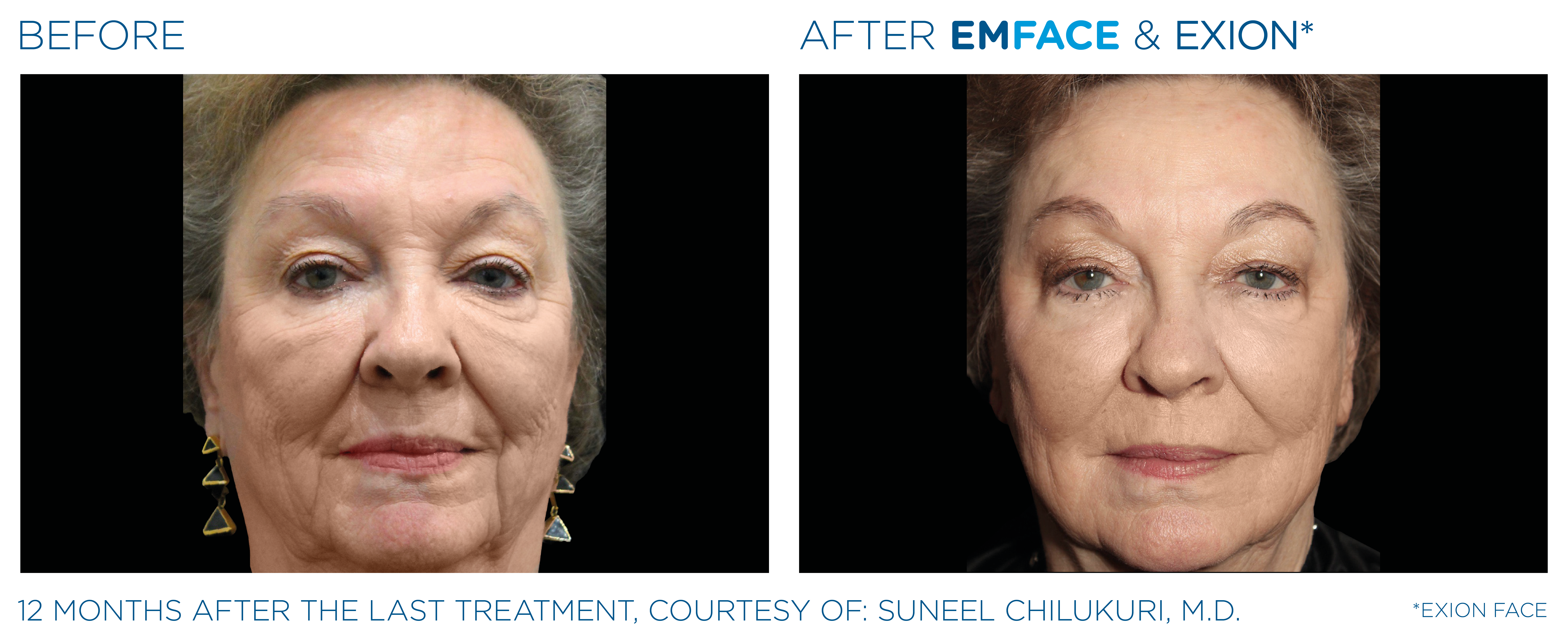 Exion face pre and post treatment before and after