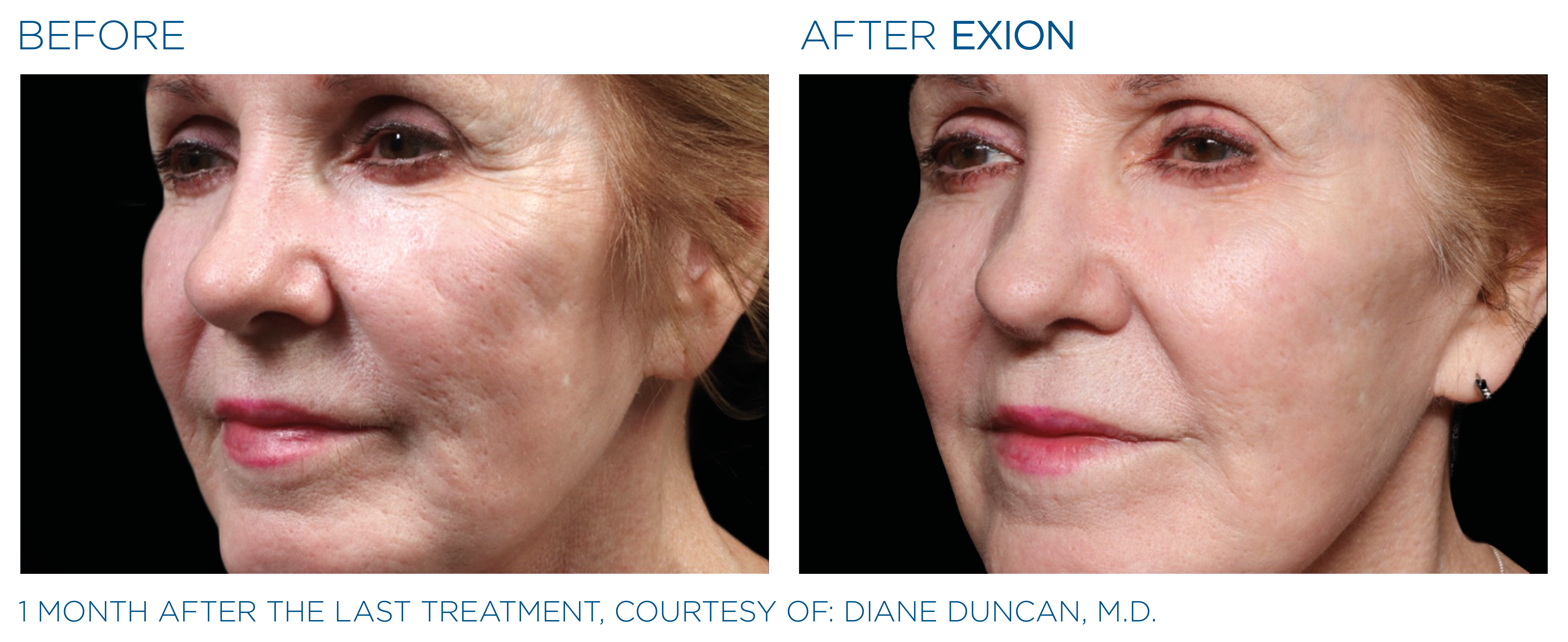 Before and after of Exion face