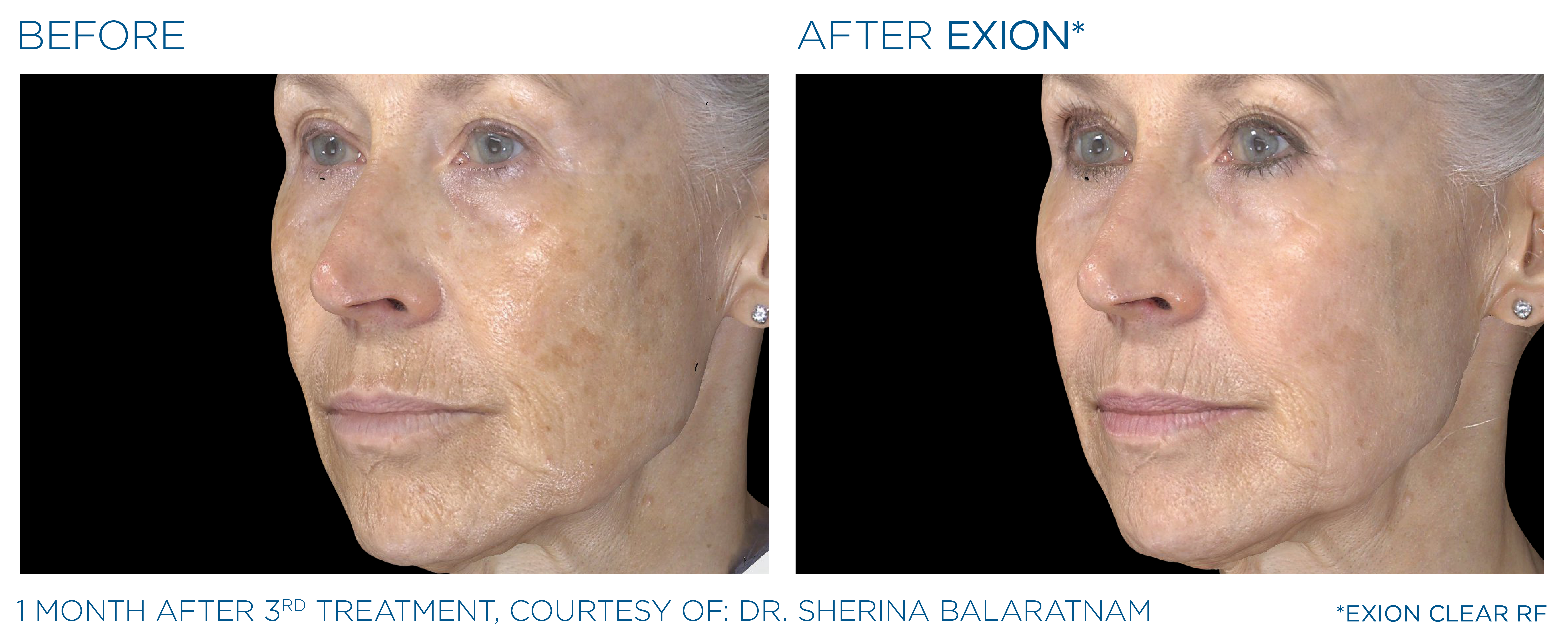 Exion fractional RF before and after