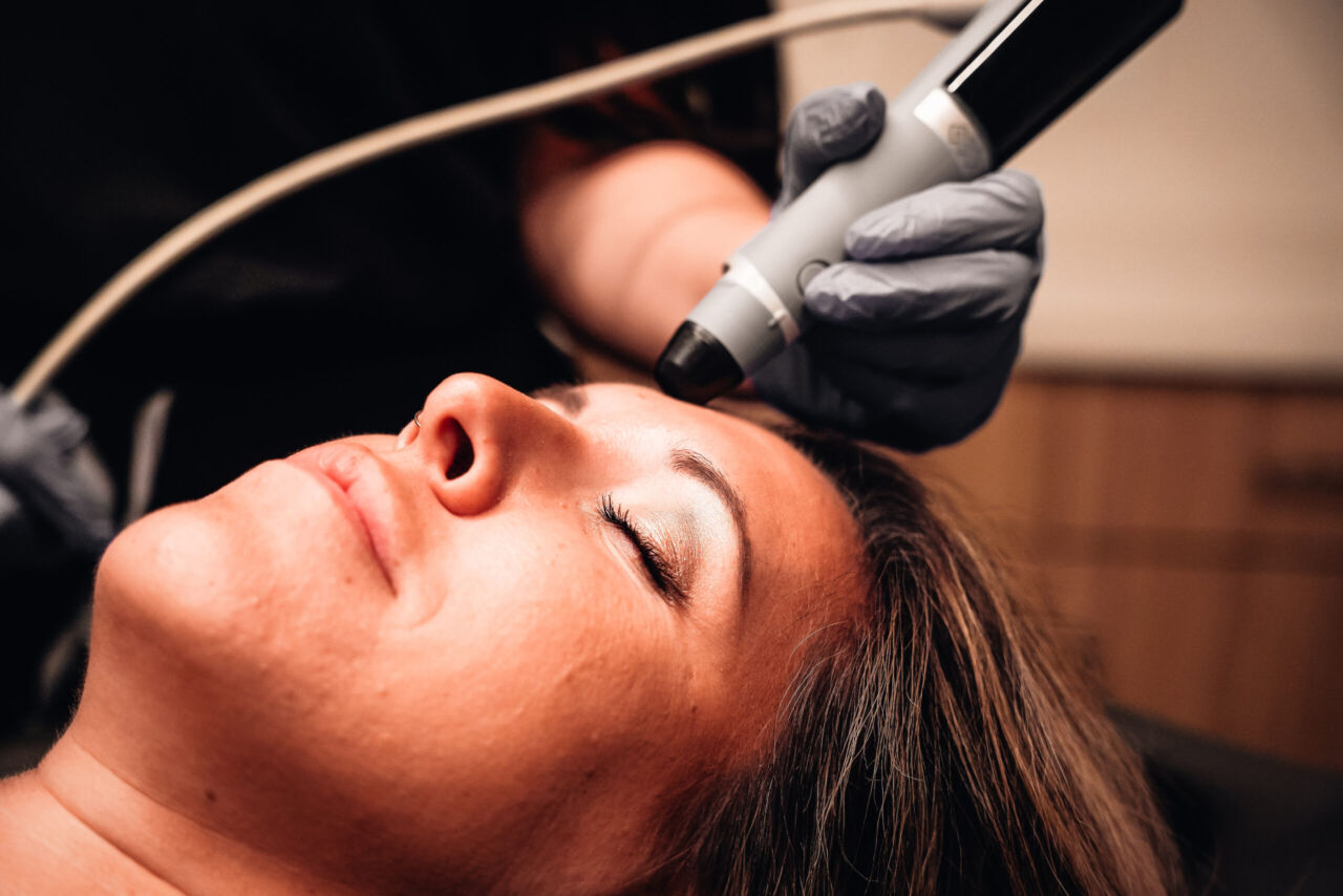 Microneedling