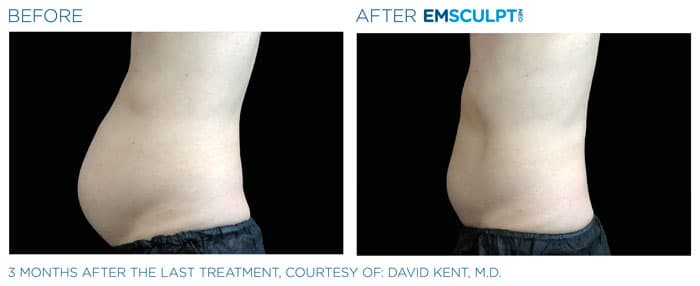 How Is EMSCULPT NEO Procedure Performed?