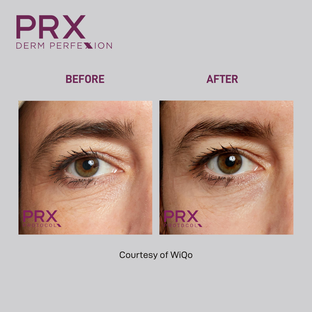 How is PRX Derm Perfexion different than a chemical peel?