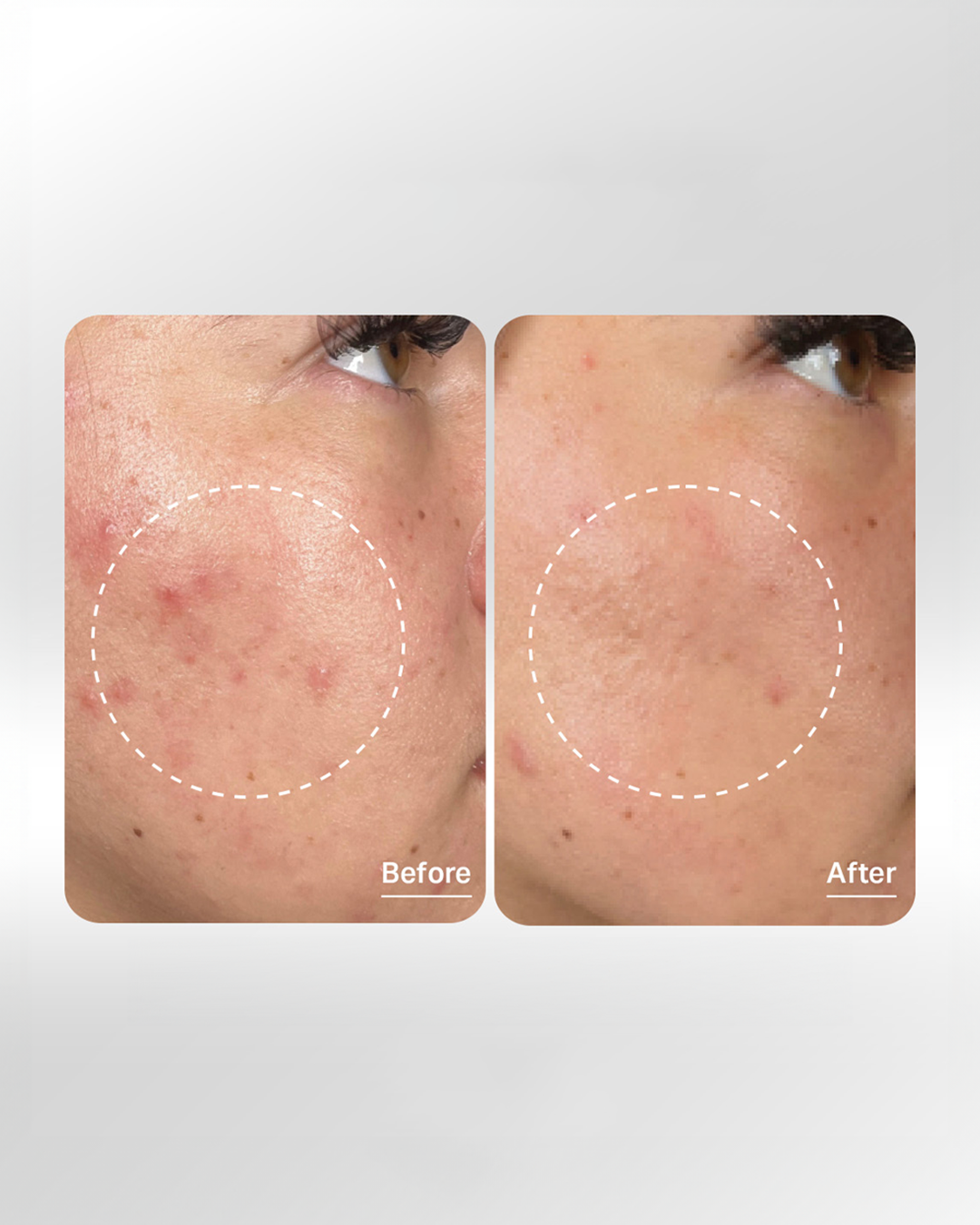 Hydrafacial Add-Ons for Enhanced Results  